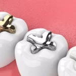 Amalgam Fillings