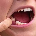 Replacing Missing Teeth With Oral Implants