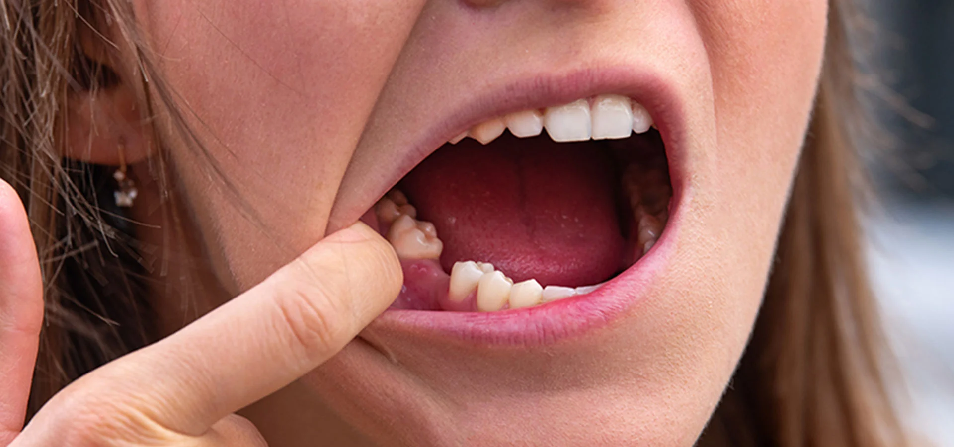 Replacing Missing Teeth With Oral Implants