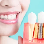 Should I Consider Dental Implants?