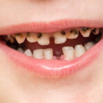 Understanding and Preventing Tooth Decay in Children